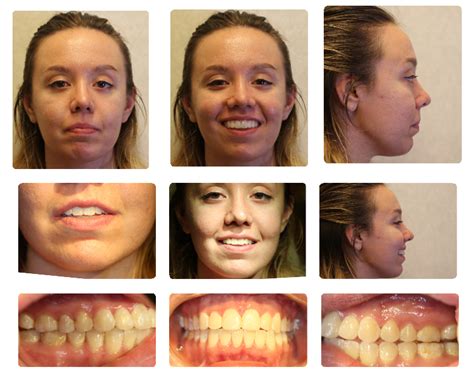 TMJ Replacement Surgery Naperville, Joliet, Yorkville IL