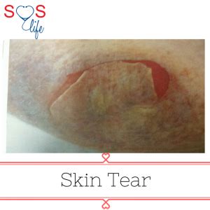 Skin tear – Wound care plan - SOS Life