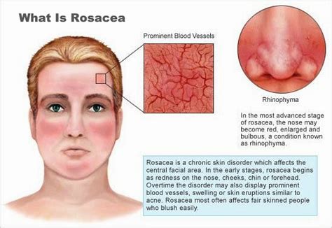 Rosacea Causes, Signs And Symptoms - Health And Medical Information