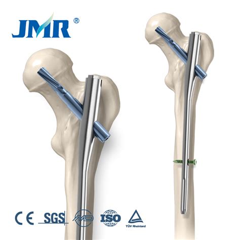 Pfna Proximal Femoral Interlocking Nail, Titanium Femur Pfn Intramedullary Implant - China Pfna ...