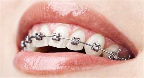 Understanding Metal Braces for Orthodontic Treatment