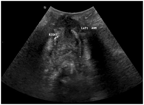 Right and left arms of a TVT mesh identified with ultrasound. | Download Scientific Diagram