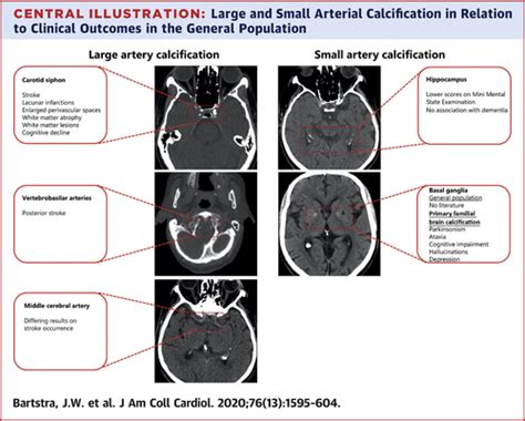 Tramline Intracranial Calcifications