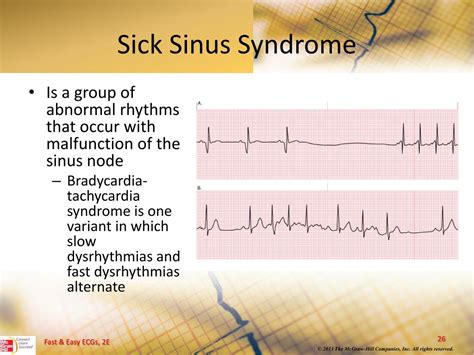 PPT - Sinus Dysrhythmias PowerPoint Presentation, free download - ID ...