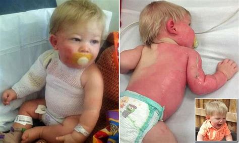 Arizona boy suffers second-degree burns after being hit by scalding hot ...