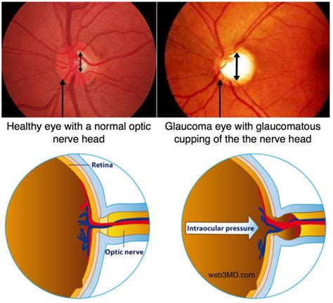 Glaucoma - High Internal Eye Pressure That Causes Vision Loss