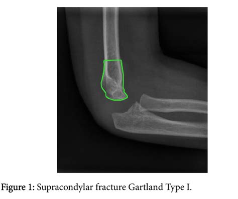 Supracondylar Fractures of the Humerus in Children: Review of Management and Controversies ...