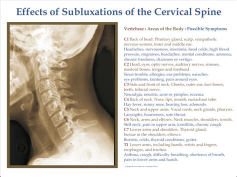 Cervical Spine Subluxation Effects Poster - Clinical Charts and Supplies