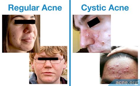 Regular Acne vs. Cystic Acne: What's the Difference? - Acne.org