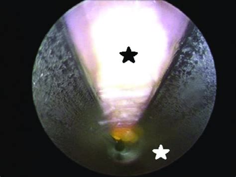 Endoscopic image of transverse carpal ligament (black star), viewed... | Download Scientific Diagram