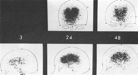 Isotope Cisternography in Hydrocephalus with Normal Pressure in: Journal of Neurosurgery Volume ...