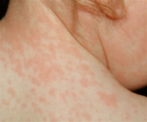 Roseola Rash | Good Health