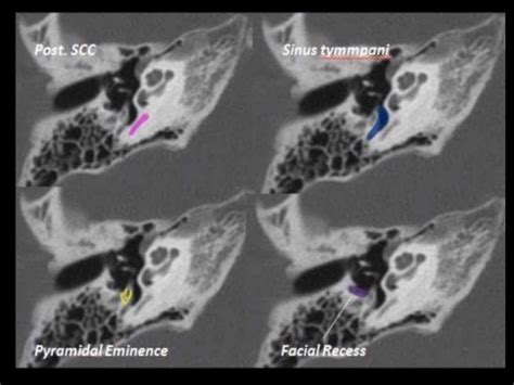 Imaging modalities of the petrous bone