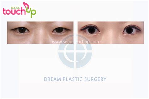 Epicanthoplasty Canthoplasty Before & After | Seoul TouchUp