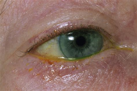 Removal of foreign body in eye - Stock Image - M155/0508 - Science ...