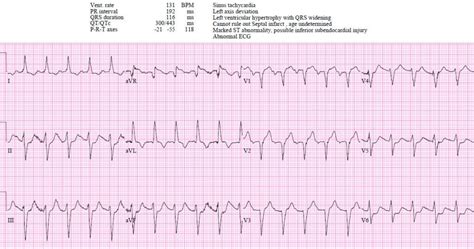 Avr St Elevation