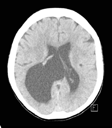 Figure 1 from Cavum velum interpositum cyst causing symptomatic trapped ...