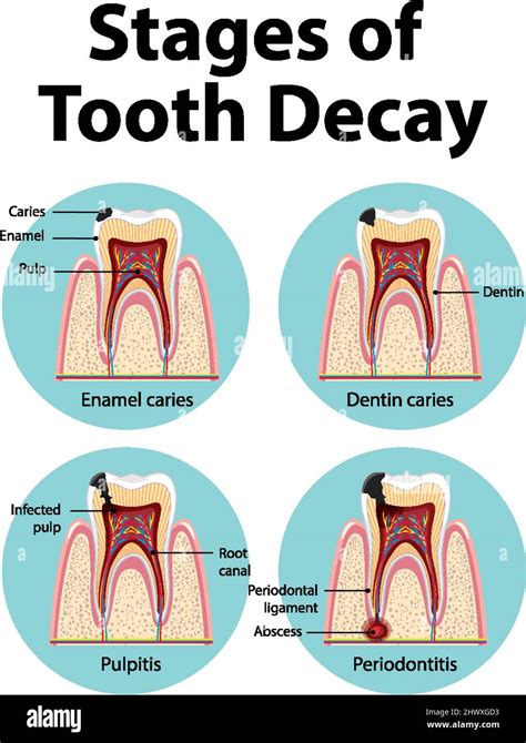 Infographic of human in the stages of tooth decay illustration Stock ...