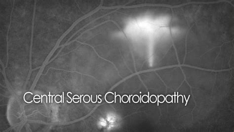 CSR - central serous retinopathy information