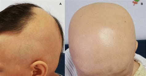 A-Patchy scalp alopecia areata at the age of 2. B-Alopecia totalis on ...