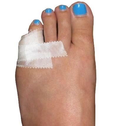 Buddy Taping or 3pp Toe Loops- Which Works Better for your Hurt Toe ...