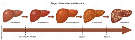 Stages of liver disease in hepatitis with description corresponding ...