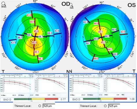 Collaborative Case #011: Treating Irregular Astigmatism After Laser Vision Correction - Modern ...