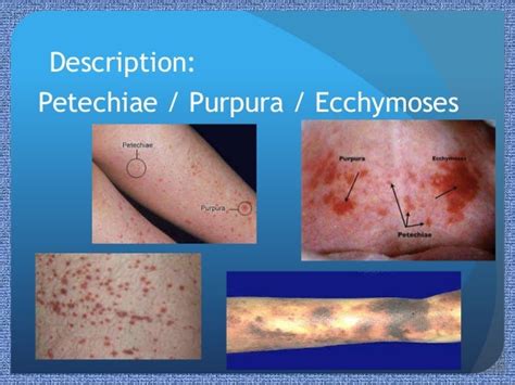 Paediatric Rashes