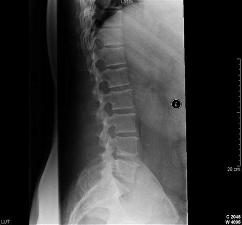 Mobile Spinal X-Ray