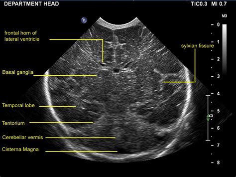 Practical guide to neonatal cranial ultrasound (CrUS): basics ...