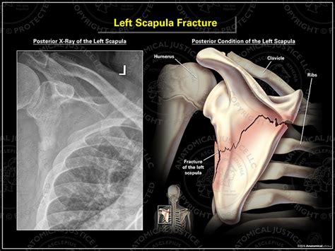 Left Scapula Fracture