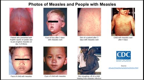 Measles | Lake County General Health