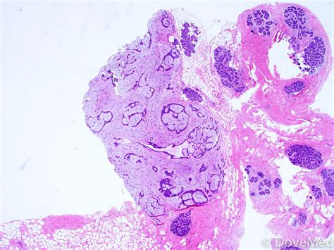 Fibroadenoma of the Breast