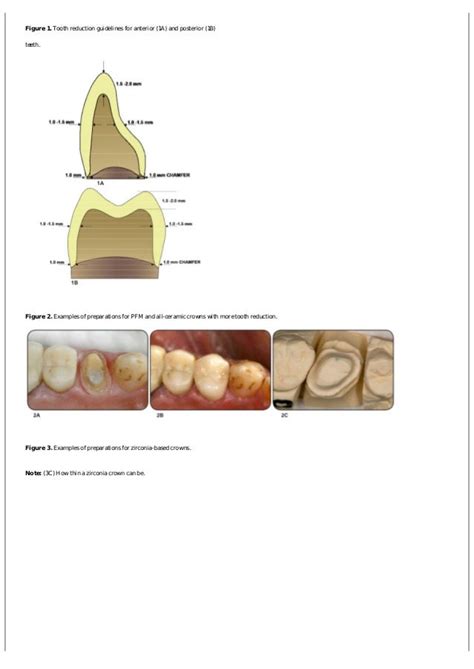 Zirconia crown preparation