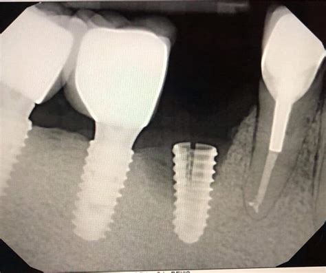 Complications- Dental Implants Break!