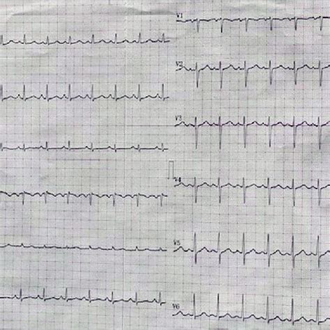 Normal echocardiogram | Download Scientific Diagram