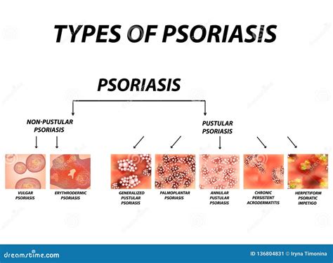 Discoid Psoriasis Pictures