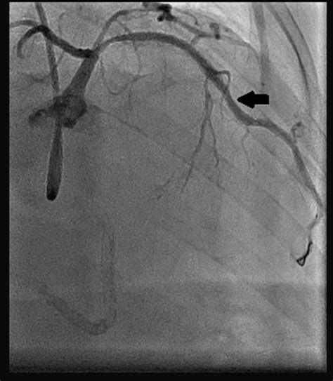 Cureus | Successful Management of Coronary In-Stent Restenosis: A Case Report and Literature Review