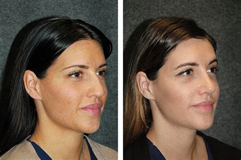 UltraSonic Rhinoplasty New York | Mini Rhinoplasty