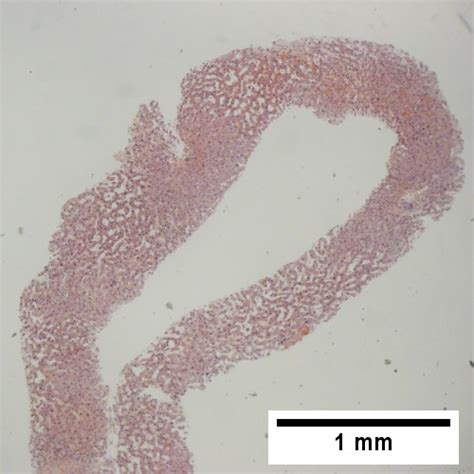 Congestive hepatopathy - Libre Pathology