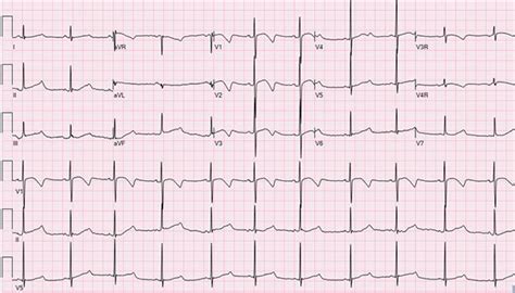 The Pediatric ECG and Long QT Syndrome EMRA