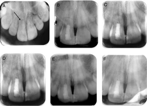 Figure 3 from Regenerative Endodontic Procedures for Traumatized Teeth after Horizontal Root ...