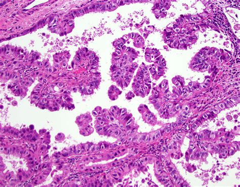 Pathology Outlines - Papillary