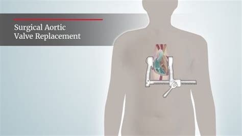 Surgical aortic valve replacement through open heart surgery