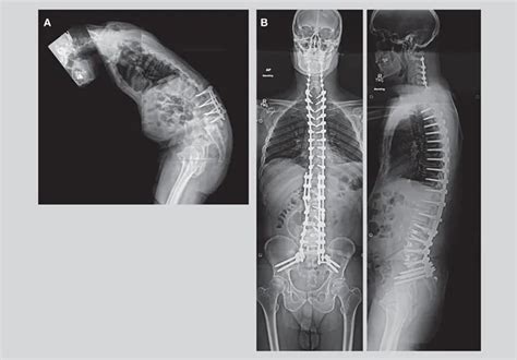 Specialized expertise for spinal deformity surgery - Mayo Clinic