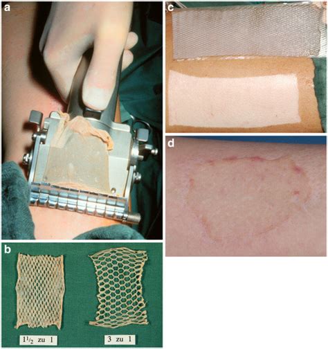 Dermatome Skin Graft Machine