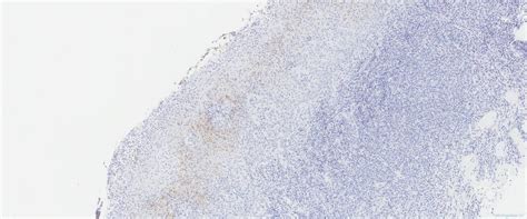 Treponema infection of the oropharynx | Ottawa Atlas of Pathology