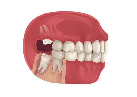 How to manage a broken wisdom tooth? Causes, risks, and treatment