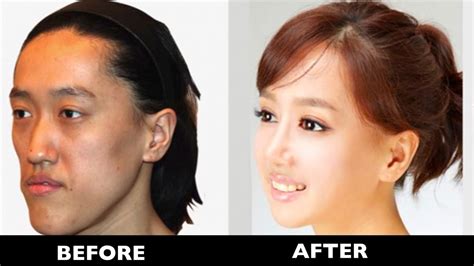 Korean Plastic Surgery Before And After