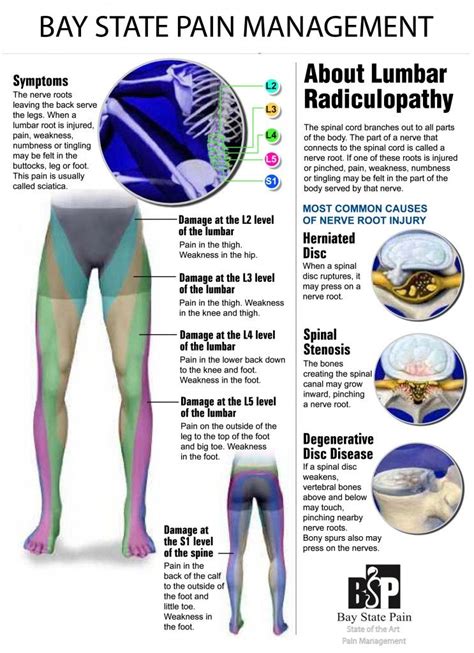 Pin on Radiculopathy